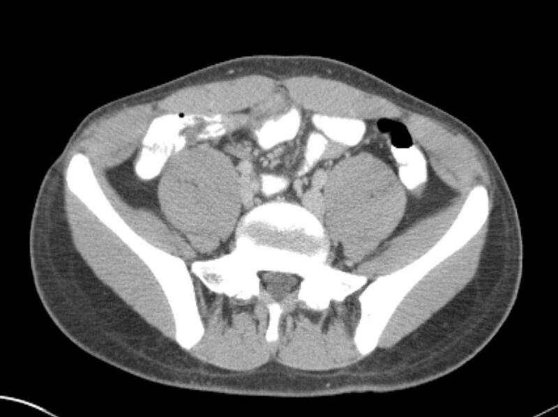 File:Appendicitis and incidental foregut duplication cyst (Radiopaedia 52962-58916 A 63).jpg