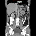Appendicitis and renal cell carcinoma (Radiopaedia 17063-16760 B 17).jpg