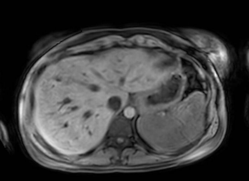 File:Appendicitis in gravida (MRI) (Radiopaedia 89433-106395 Axial DIXON 12).jpg