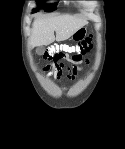 File:Appendicitis with cecal bar sign (Radiopaedia 31878-32830 A 13).jpg