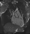 Arrhythmogenic right ventricular cardiomyopathy (Radiopaedia 57972-64966 CINE R2 SSFP 38).jpg