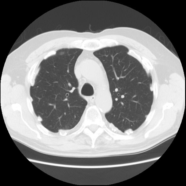 File:Asbestos-related pleural plaques (Radiopaedia 39069-41255 Axial lung window 23).jpg