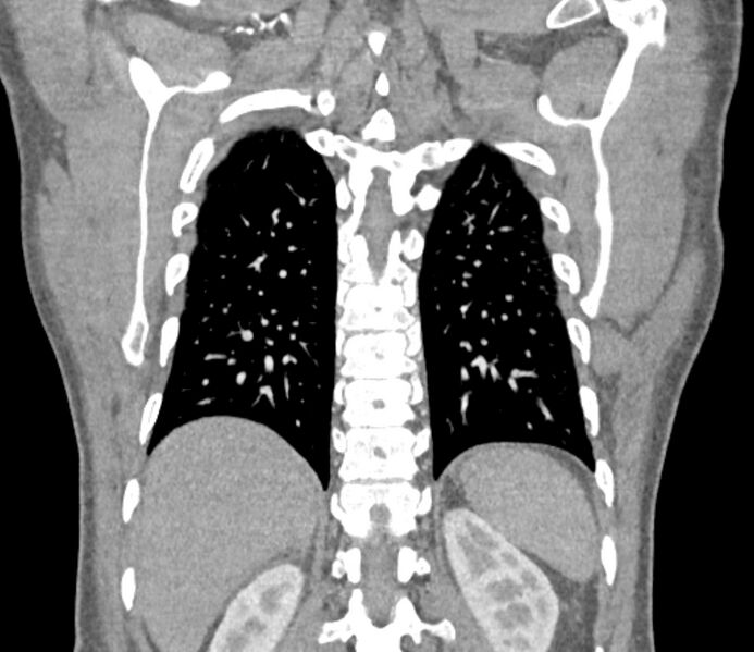 File:Ascending aortic aneurysm (Radiopaedia 86279-102297 B 53).jpg