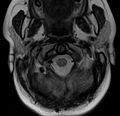 Astrocytoma - spinal cord (Radiopaedia 69769-79758 Axial T2 4).jpg