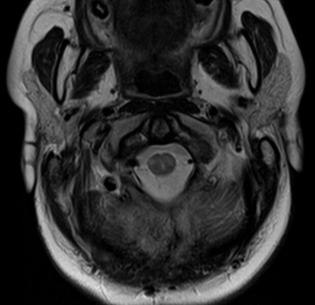 File:Astrocytoma - spinal cord (Radiopaedia 69769-79758 Axial T2 4).jpg