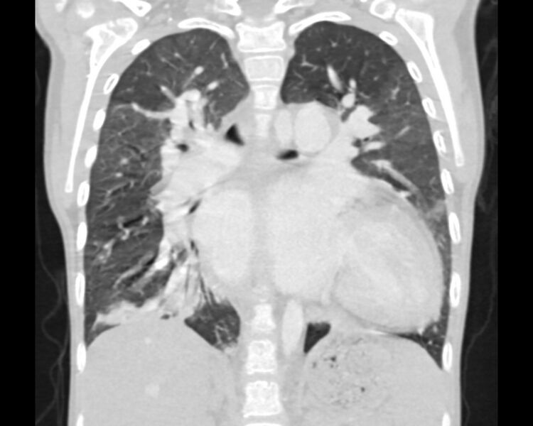 File:Atrial septal defect complicated by Eisenmenger syndrome (Radiopaedia 53707-59768 Sagittal lung window 15).jpg