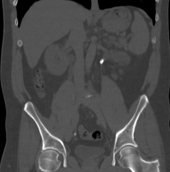 File:Atrophic kidney due to severe chronic obstructive hydronephrosis (Radiopaedia 40828-43474 Coronal bone window 3).jpg