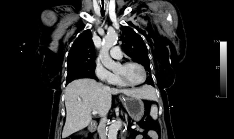 File:Atypical dissection of the thoracic aorta (Radiopaedia 10975-78320 B 10).jpg
