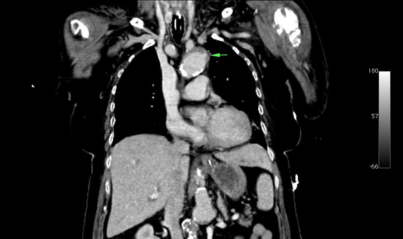 File:Atypical dissection of the thoracic aorta (Radiopaedia 10975-78320 B 13).jpg