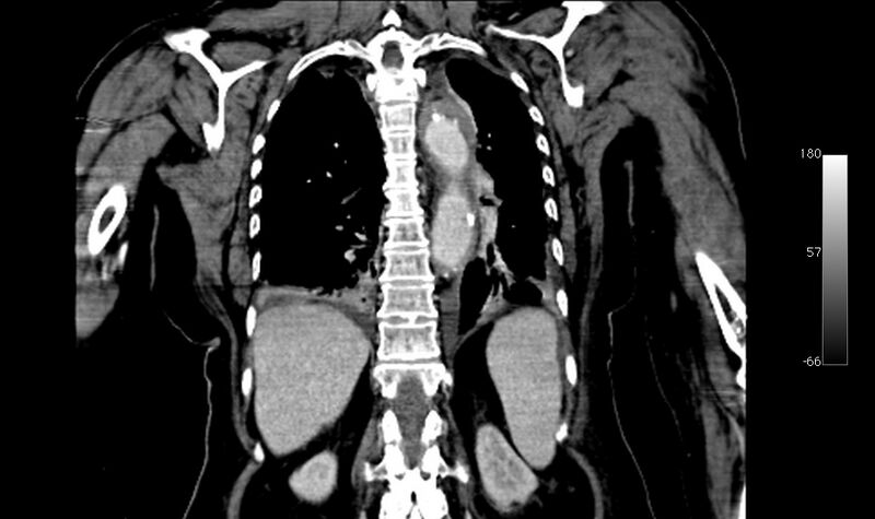 File:Atypical dissection of the thoracic aorta (Radiopaedia 10975-78320 B 34).jpg