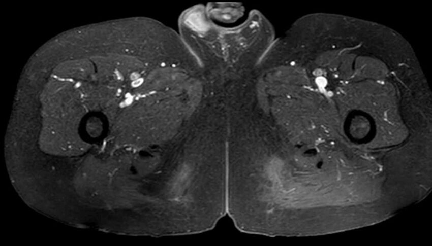 Atypical lipomatous tumor - thigh (Radiopaedia 68975-78734 Axial T1 C+ fat sat 74).jpg