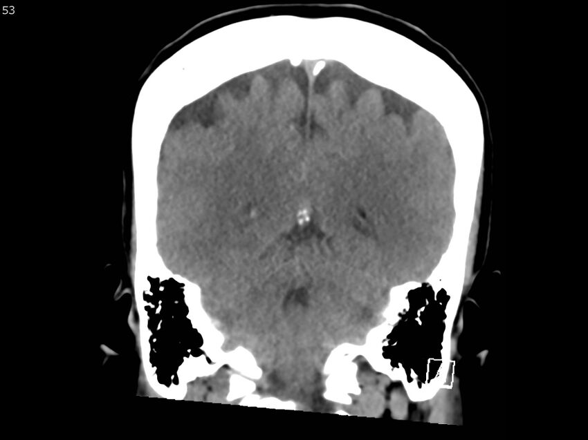 Atypical meningioma - intraosseous (Radiopaedia 64915-73867 B 52).jpg