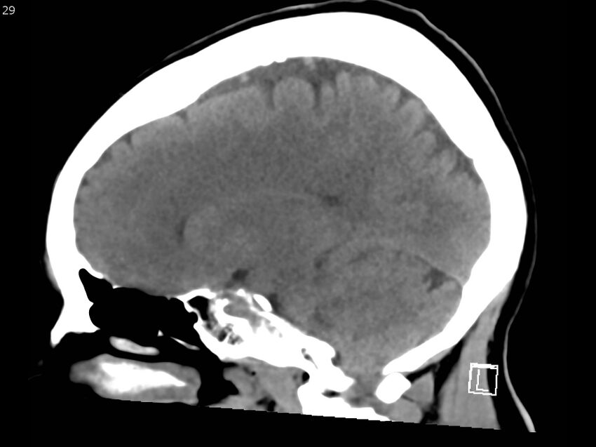 Atypical meningioma - intraosseous (Radiopaedia 64915-73867 C 27).jpg