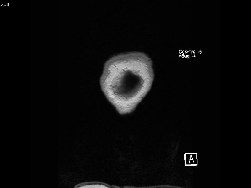 File:Atypical meningioma - intraosseous (Radiopaedia 64915-74572 Coronal T1 208).jpg
