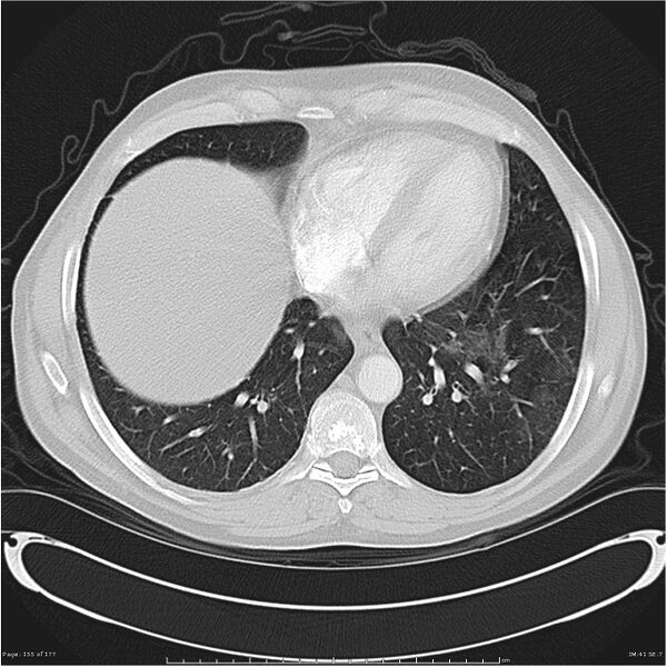 File:Atypical pneumonia - Q fever (Radiopaedia 21993-21989 lung window 34).jpg