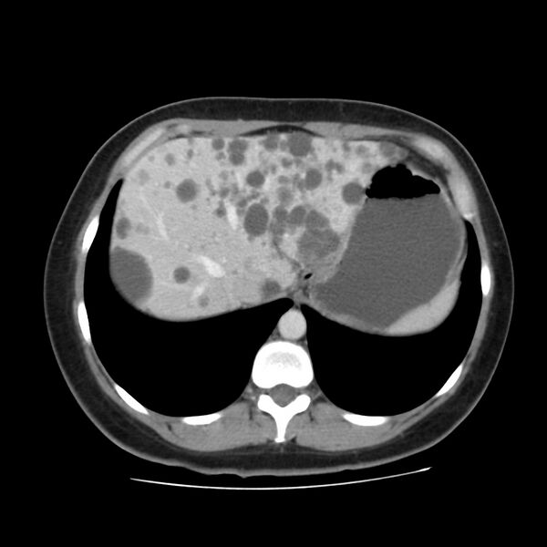 File:Autosomal dominant polycystic kidney disease (Radiopaedia 23061-23093 C 11).jpg