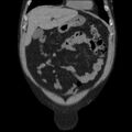 Autosomal dominant polycystic kidney disease (Radiopaedia 36539-38101 C 17).jpg