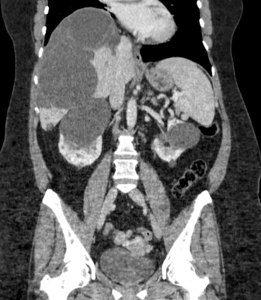 File:Autosomal dominant polycystic kidney disease (Radiopaedia 57124-64017 B 43).jpg