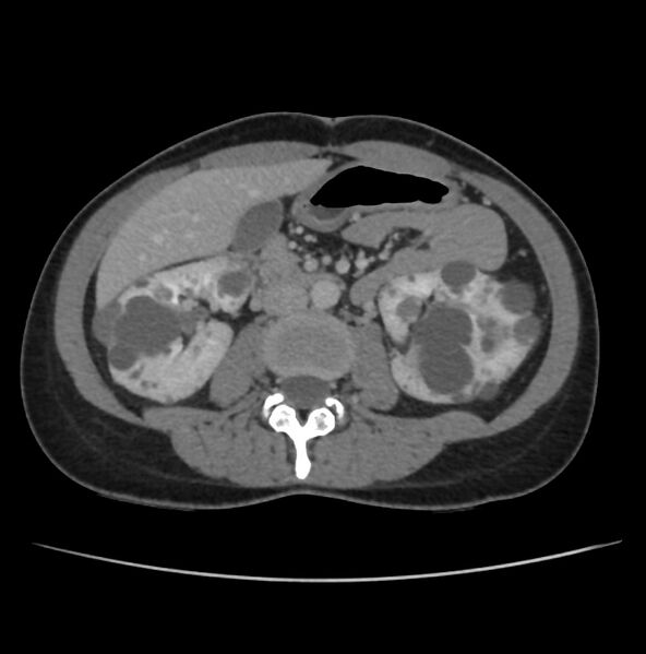 File:Autosomal dominant polycystic kidney disease - early onset (Radiopaedia 40734-43387 A 40).jpg