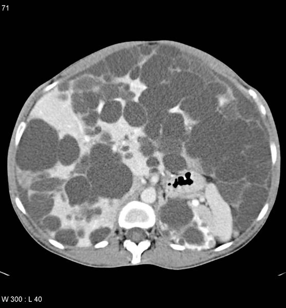File:Autosomal dominant polycystic kidney disease with extensive hepatic involvement (Radiopaedia 5204-6971 B 8).jpg