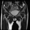 Avascular necrosis of the hip (Radiopaedia 29563-30067 Coronal T2 3).jpg