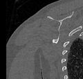 Avulsion fracture - greater tuberosity of humerus (Radiopaedia 71216-81514 Coronal bone window 62).jpg