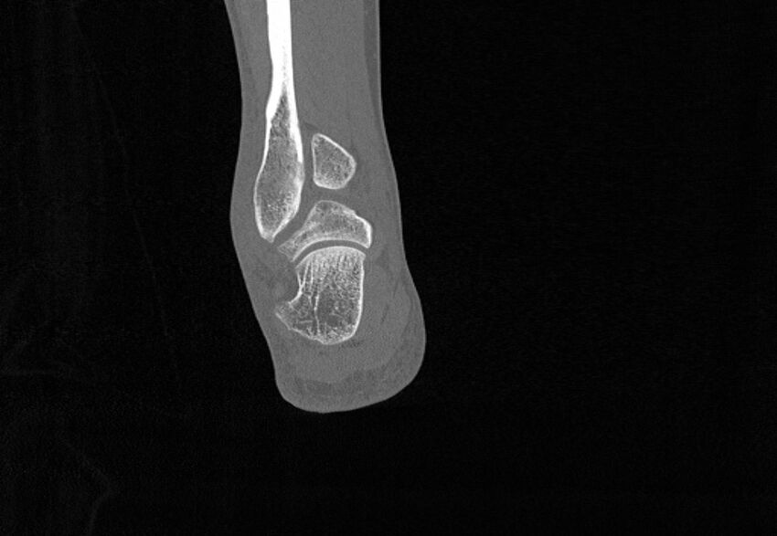 Avulsion fractures of talus and calcaneus (Radiopaedia 48277-53155 Coronal bone window 80).jpg