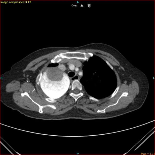 File:Azygos vein aneurysm (Radiopaedia 77824-90130 B 15).jpg
