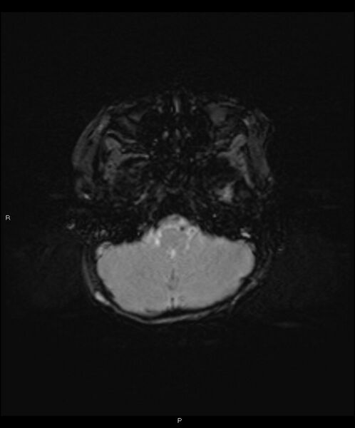 File:Basal ganglia and parenchymal ischemia (Radiopaedia 45818-50084 Axial SWI 7).jpg