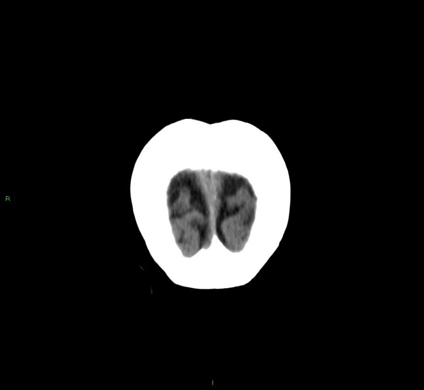 Basal ganglia hemorrhage (Radiopaedia 58762-65984 Coronal non-contrast 6).jpg
