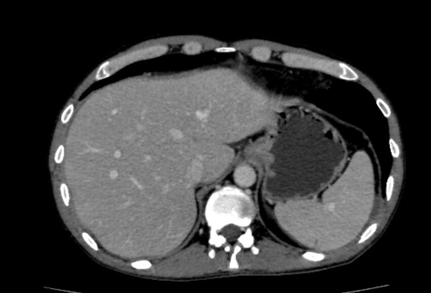 Behçet's disease- abdominal vasculitis (Radiopaedia 55955-62570 A 8).jpg