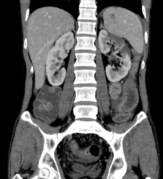 File:Behçet's disease- abdominal vasculitis (Radiopaedia 55955-62570 B 40).jpg