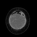 Benign leiomyoma with hydropic features (Radiopaedia 89250-106130 B 15).jpg
