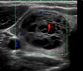Benign thyroid lesion (ultrasound) (Radiopaedia 21889).png