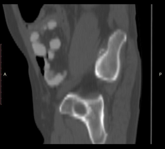 File:Bertolotti syndrome (Radiopaedia 58974-66235 Sagittal bone window 56).jpg