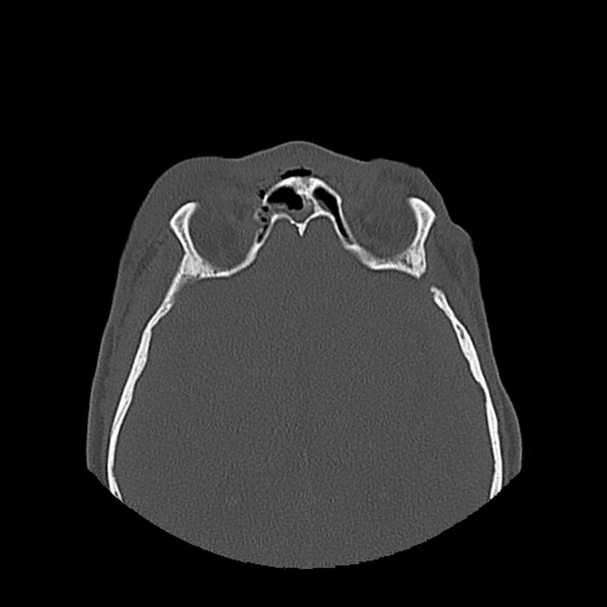Bilateral Le Fort fractures (Radiopaedia 32192-33135 Axial bone window 73).jpg