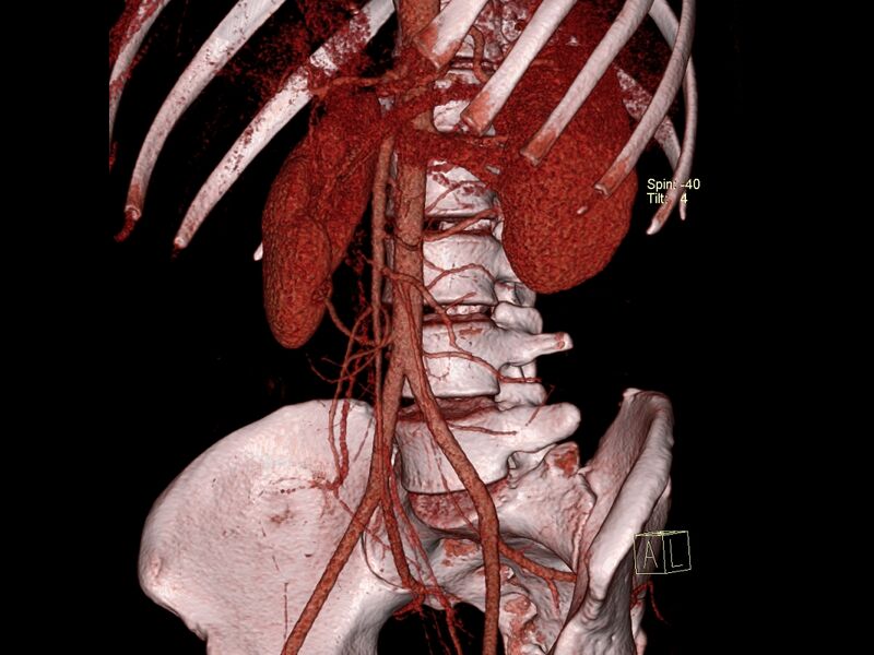 File:Bilateral accessory renal arteries with mild pelvi-ureteric junction (PUJ) obstruction (Radiopaedia 66357-75596 C 4).jpg