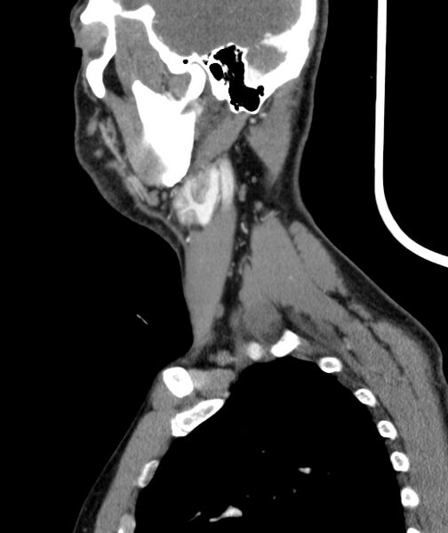 File:Bilateral carotid body tumors (Radiopaedia 52899-58827 C 3).jpg