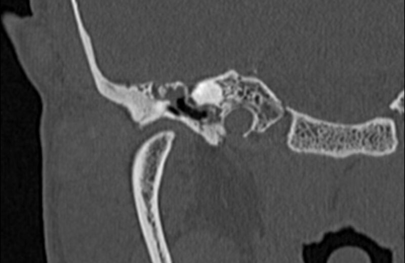 File:Bilateral cholesteatoma (Radiopaedia 54898-61172 Coronal bone window 20).jpg