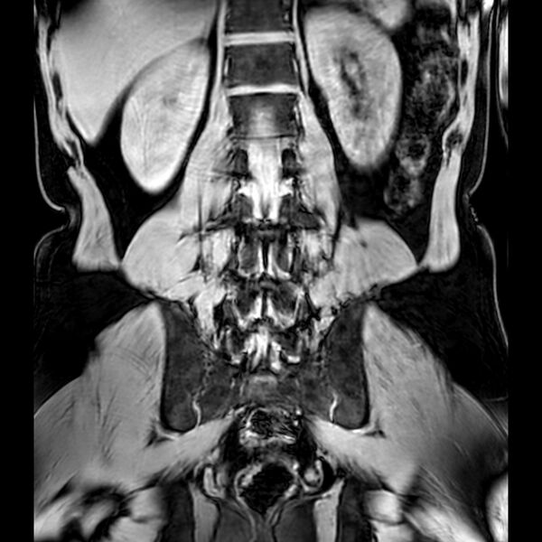 File:Bilateral conjoined nerve roots at different levels (Radiopaedia 73312-84063 Coronal WE 35).jpg
