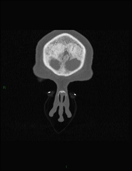 File:Bilateral frontal mucoceles (Radiopaedia 82352-96454 Coronal 34).jpg