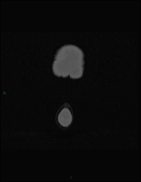 File:Bilateral frontal mucoceles (Radiopaedia 82352-96454 Coronal 7).jpg