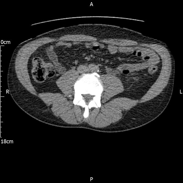 File:Bilateral medullary nephrocalcinosis with ureteric calculi (Radiopaedia 71269-81569 Axial non-contrast 72).jpg