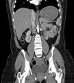Bilateral ovarian mature cystic teratomas (Radiopaedia 79373-92457 B 41).jpg