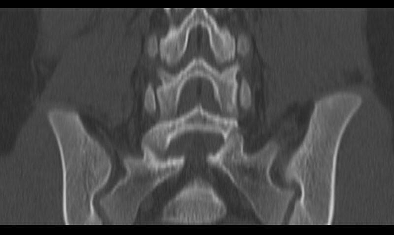 File:Bilateral pars defect (Radiopaedia 26691-26846 Coronal bone window 32).jpg