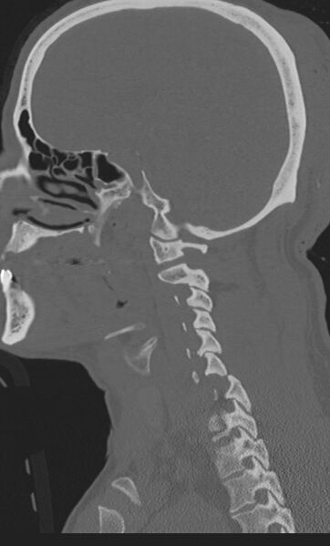 File:Bilateral perched facet joint (Radiopaedia 63149-71669 Sagittal bone window 9).jpg