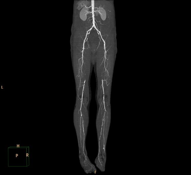File:Bilateral superficial femoral arterial occlusion (Radiopaedia 25682-25857 3D MIP 13).jpg