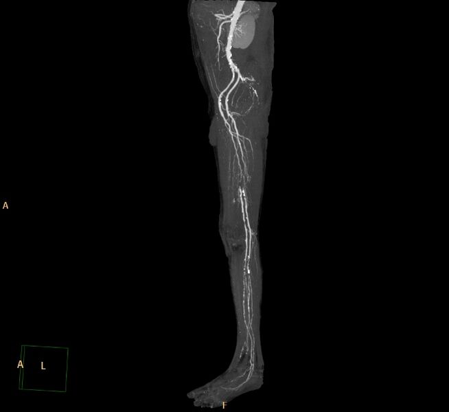 File:Bilateral superficial femoral arterial occlusion (Radiopaedia 25682-25857 3D MIP 20).jpg