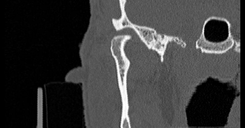 File:Bilateral temporal bone fractures (Radiopaedia 29482-29970 Coronal 121).jpg