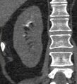 Bile leak from accessory duct(s) of Luschka post cholecystectomy (Radiopaedia 40736-43389 B 57).jpg